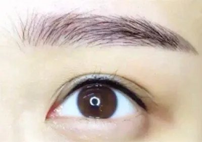 外切去眼袋要多少钱