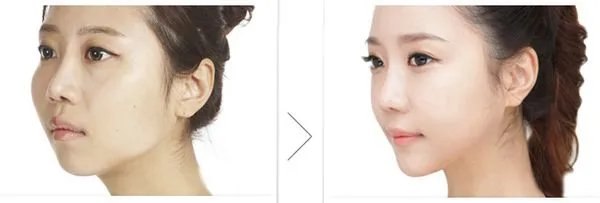 做隆鼻手术会有危害吗？