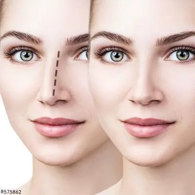 玻尿酸注射隆鼻价格是多少钱