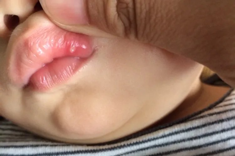 婴儿口疮和鹅口疮有什么区别图片