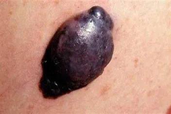 恶性黑色素瘤图片