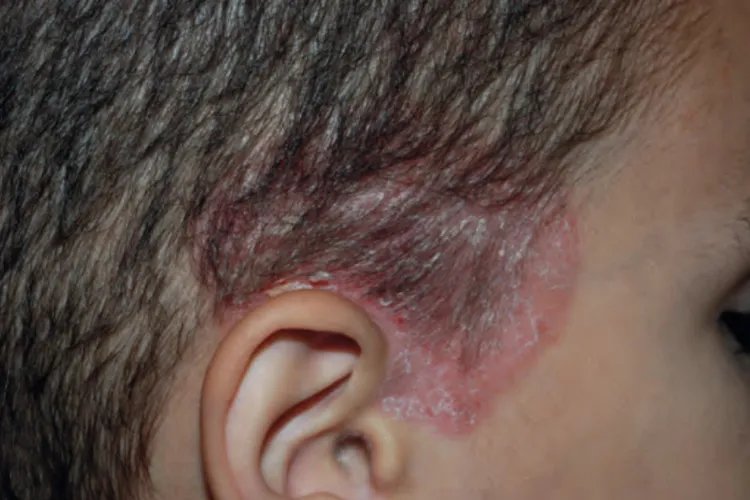 牛皮癣的几种症状图片