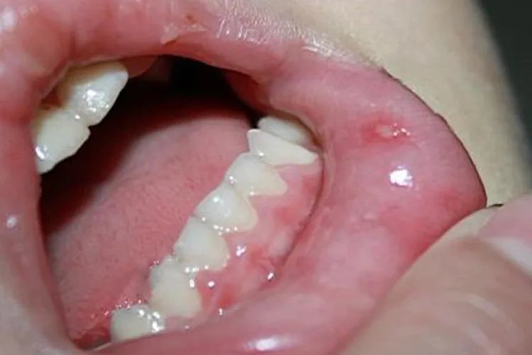 儿童手足口病高清图片