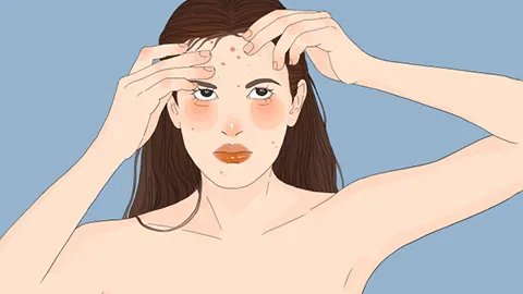 青春痘痤疮如何治疗