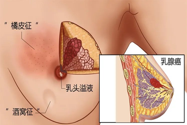 女性乳腺癌早期的图片大全