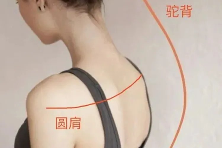 圆肩驼背图片