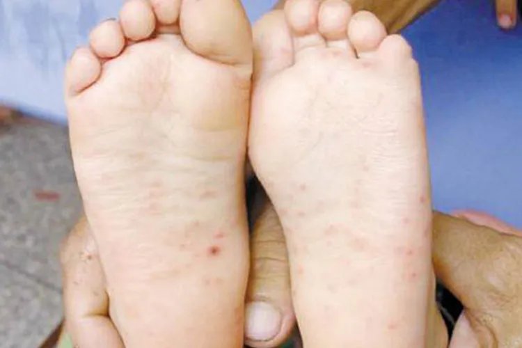 宝宝手足口病初期症状图片