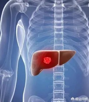 李咏得了什么病？