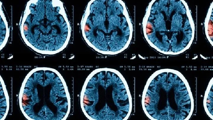 脑瘫诊断检查的方法有哪些