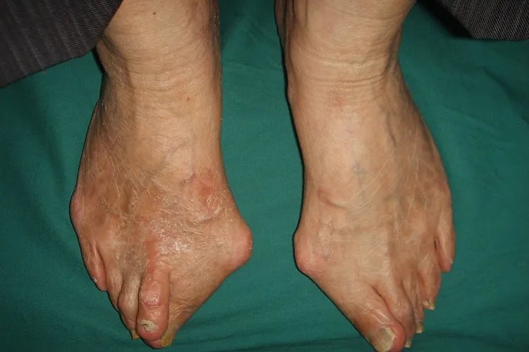 大脚骨严重图片