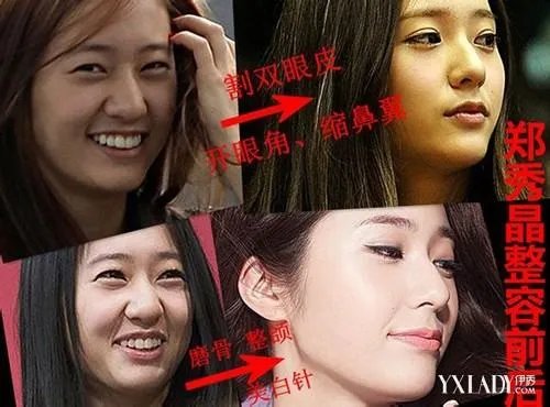 fx组合谁整容了