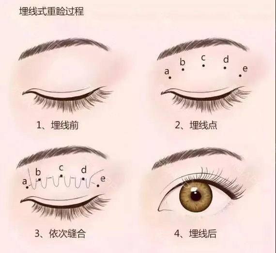 埋线双眼皮能维持多久？