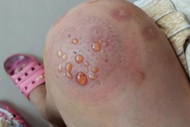 拔罐的颜色代表什么图解