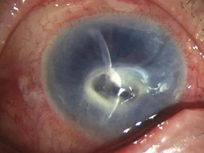 细菌性角膜炎症状图片