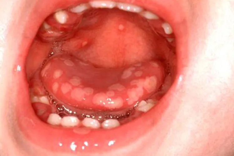 疱疹长什么样子图