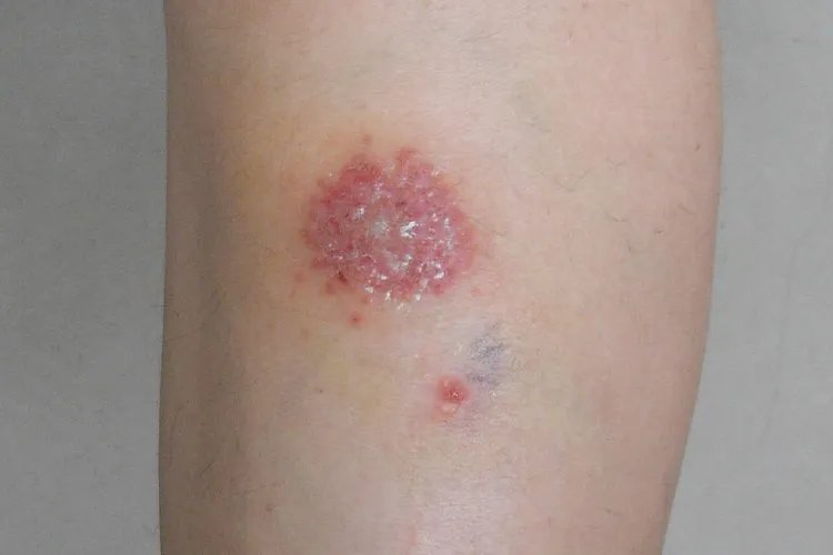 皮肤湿疹是什么样子的