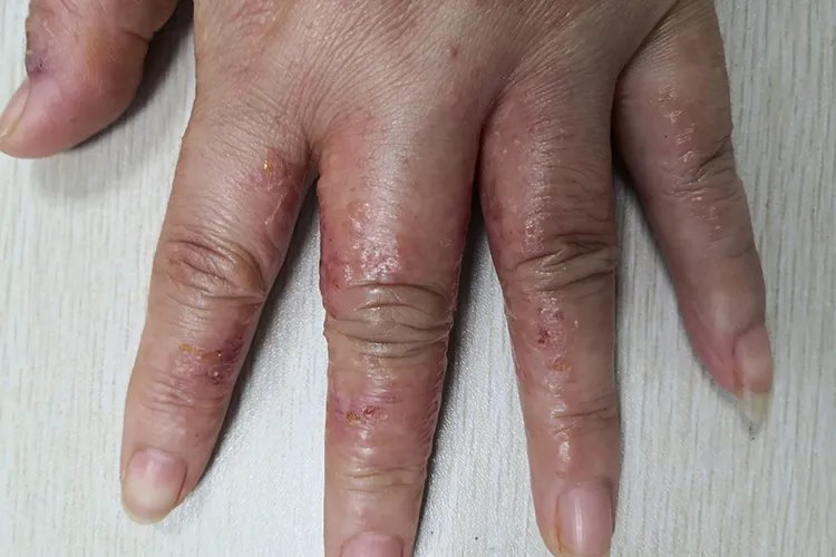 手上起小水疱很痒怎么回事图片