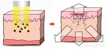 激光祛斑真的有效吗？