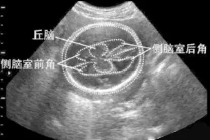 正常胎儿颅内结构图