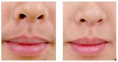 冰点激光脱毛要多少钱