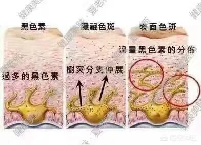 激光祛斑真的有效吗？