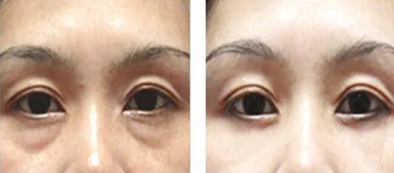 去眼袋大概需要多少钱