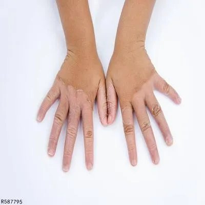 小孩手上白癜风怎么治疗