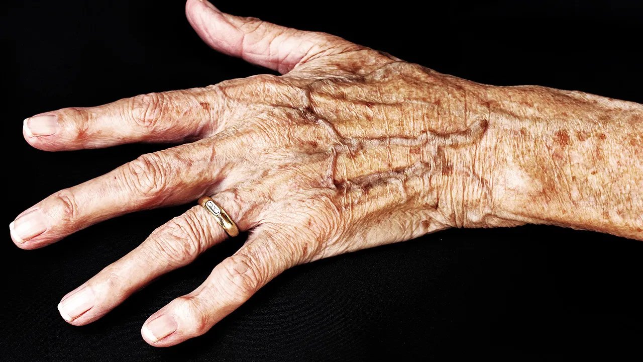 激光去老年斑效果如何