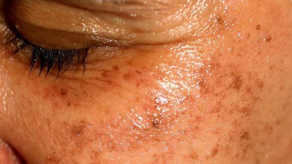 怎样去除脸上老年斑