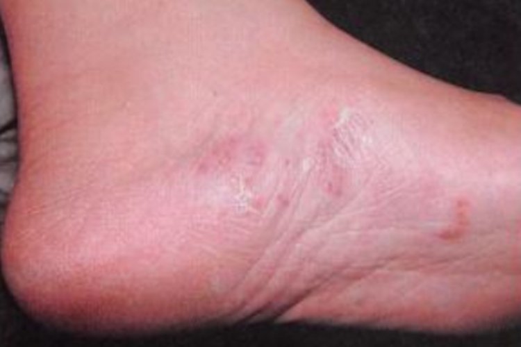 脚底皮肤病图片大全