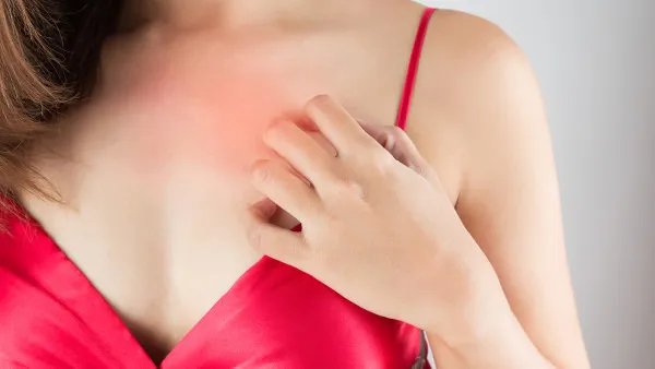 丘疹性荨麻疹怎么治疗