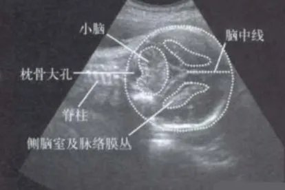 正常胎儿颅内结构图