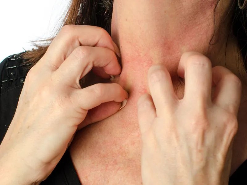 脂溢性皮炎的症状