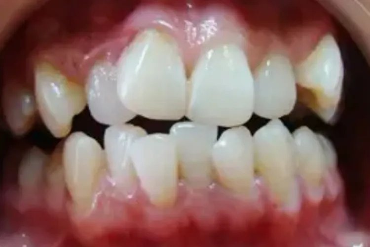 牙齿矫正前后对比图