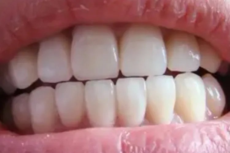 牙齿矫正前后对比图