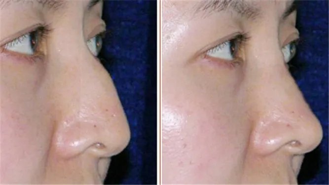 驼峰鼻整形价格