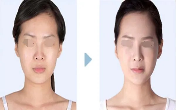 隆鼻用硅胶好还是膨体好