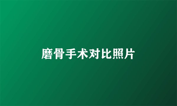 磨骨手术对比照片
