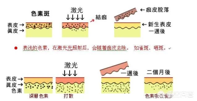 激光祛斑真的有效吗？