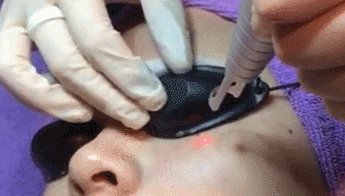 激光祛斑真的有效吗？