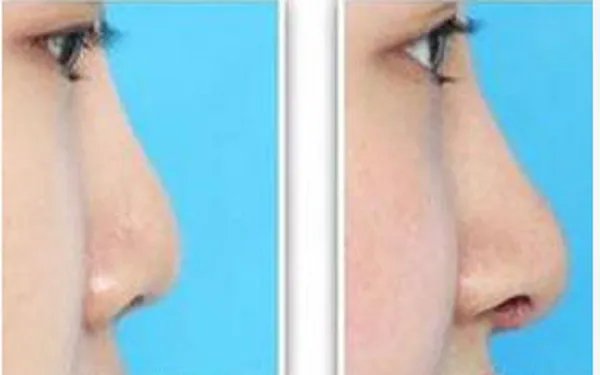 鼻部整形术需要多少钱