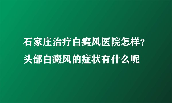 石家庄治疗白癜风医院怎样？头部白癜风的症状有什么呢