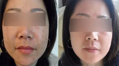 激光美白全身价格