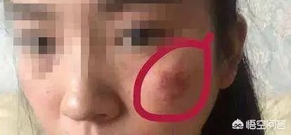 激光祛斑真的有效吗？