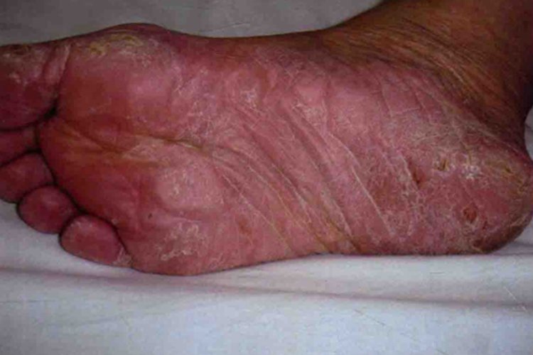 脚底皮肤病图片大全