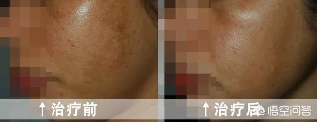 激光祛斑真的有效吗？