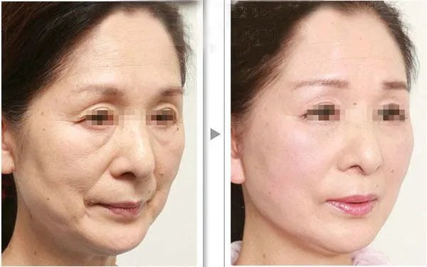 激光除皱多少钱