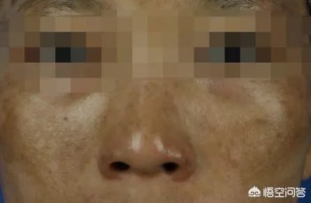 激光祛斑真的有效吗？