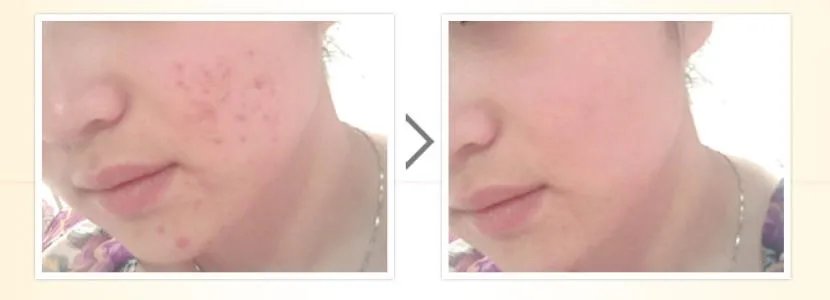 果酸换肤能去痘坑吗