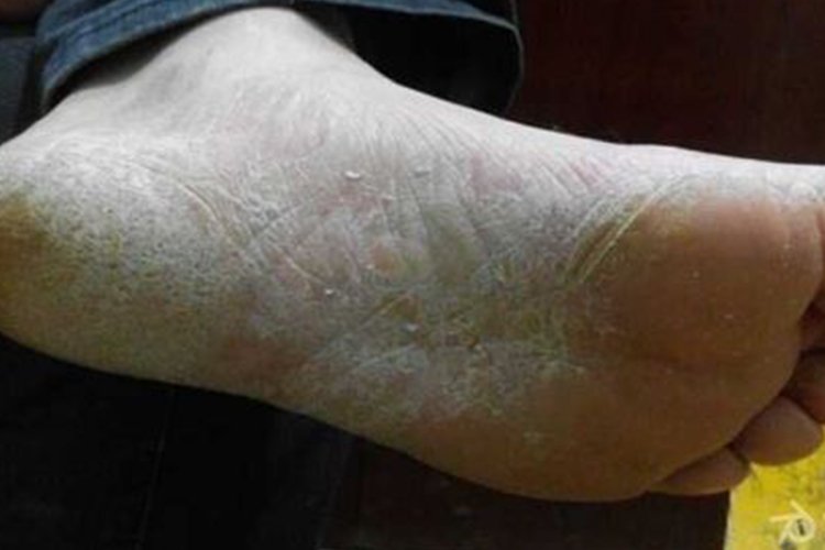 脚底皮肤病图片大全